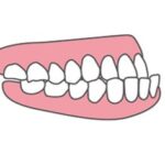 受け口のイラスト