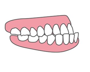 受け口のイラスト