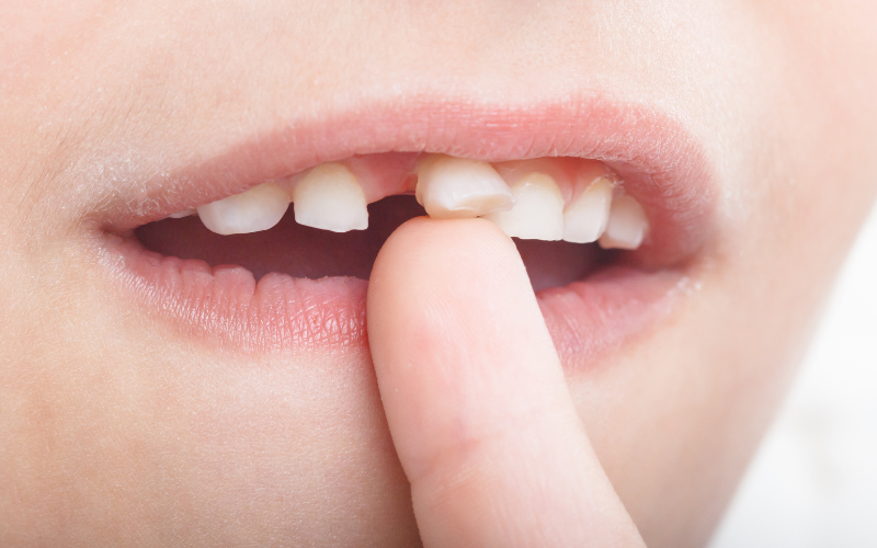 子供のグラグラしている歯