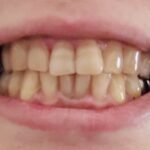 子どもの歯が茶色いのはなぜ？