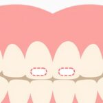 子供の歯に白い点ができたら？