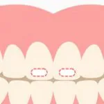 子供の歯に白い点ができたら？