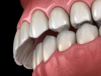 出っ歯のイメージ
